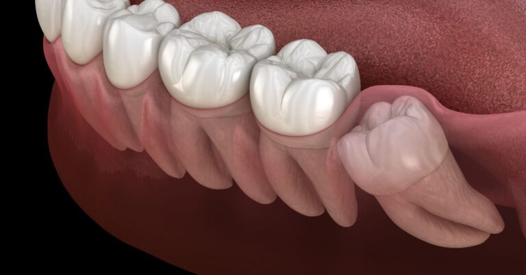 Can Wisdom Teeth Straighten Themselves Out?